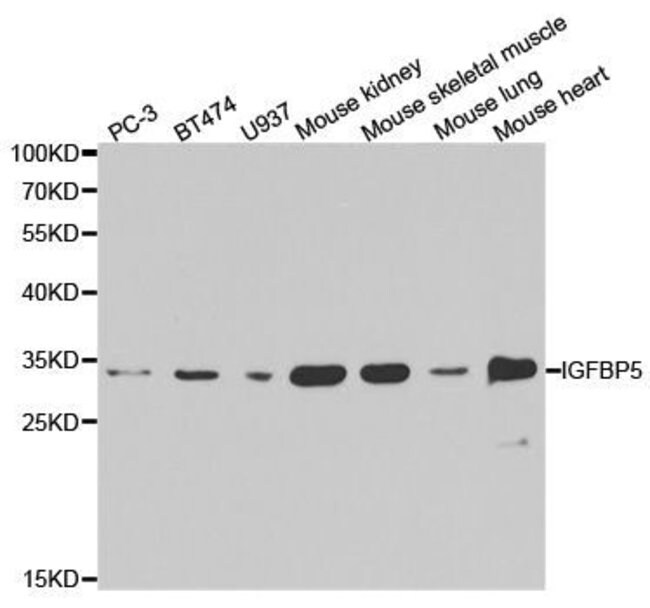 diabetes igfbp5